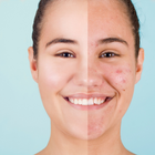 Acne & Blemish Prone Skin-Lillys Pharmacy & Health Store