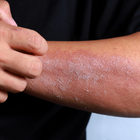 Dry Skin-Lillys Pharmacy & Health Store