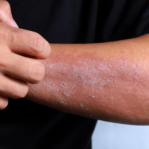 Dry Skin-Lillys Pharmacy & Health Store