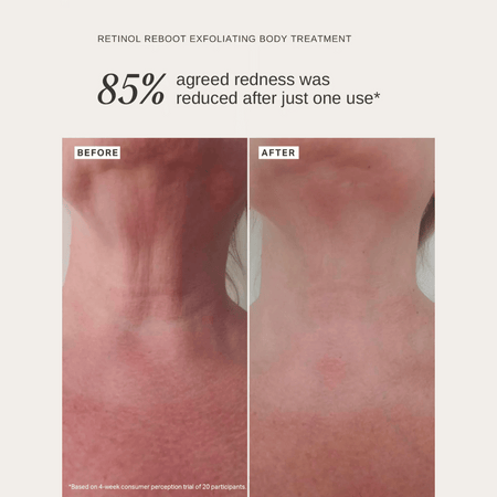 Alpha-H Retinol Reboot Exfoliating Body Treatment 120ml- Lillys Pharmacy and Health Store