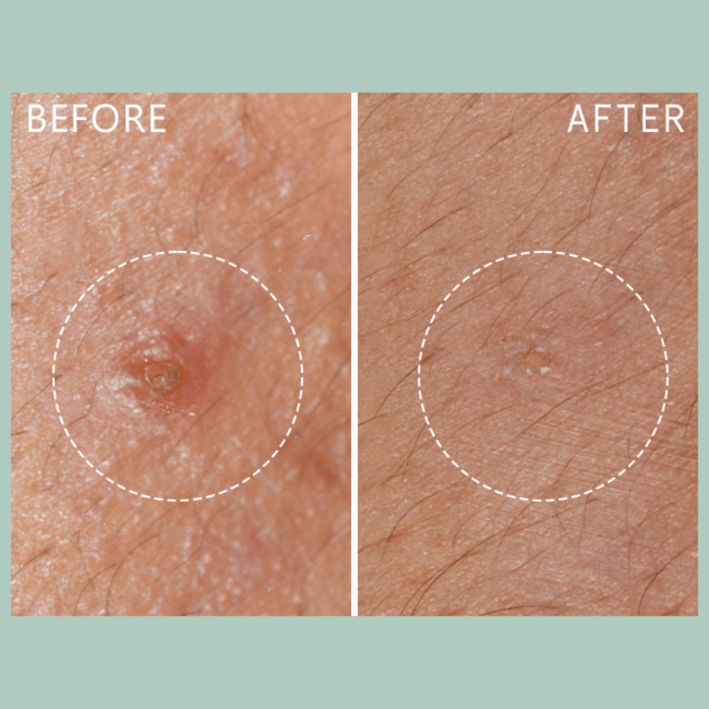 Lierac Anti-Blemish Protocol The Stop Spots 15ml- Lillys Pharmacy and Health Store