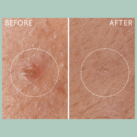 Lierac Anti-Blemish Protocol The Stop Spots 15ml- Lillys Pharmacy and Health Store