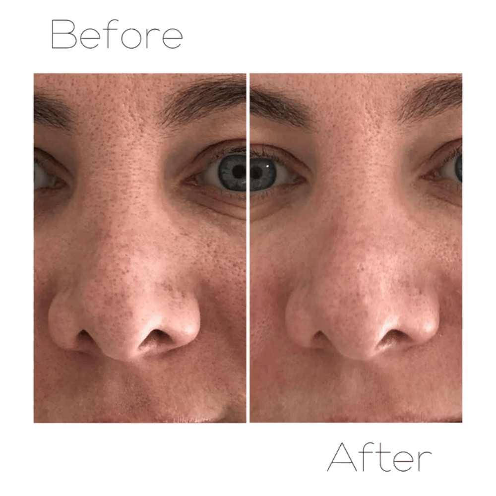 Skin Krush Microdermabrasion Kit- Lillys Pharmacy and Health Store