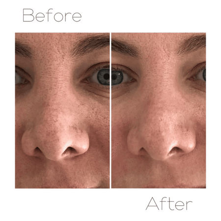 Skin Krush Microdermabrasion Kit- Lillys Pharmacy and Health Store