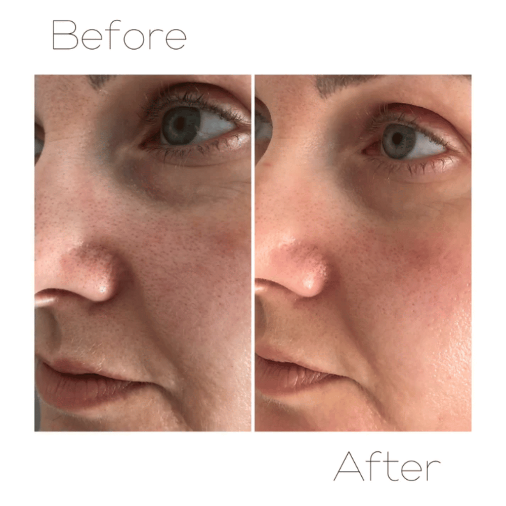 Skin Krush Microdermabrasion Kit- Lillys Pharmacy and Health Store