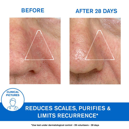 Uriage D.S. Regulating Emulsion, Irritation, Redness, Scales 40ml- Lillys Pharmacy and Health Store