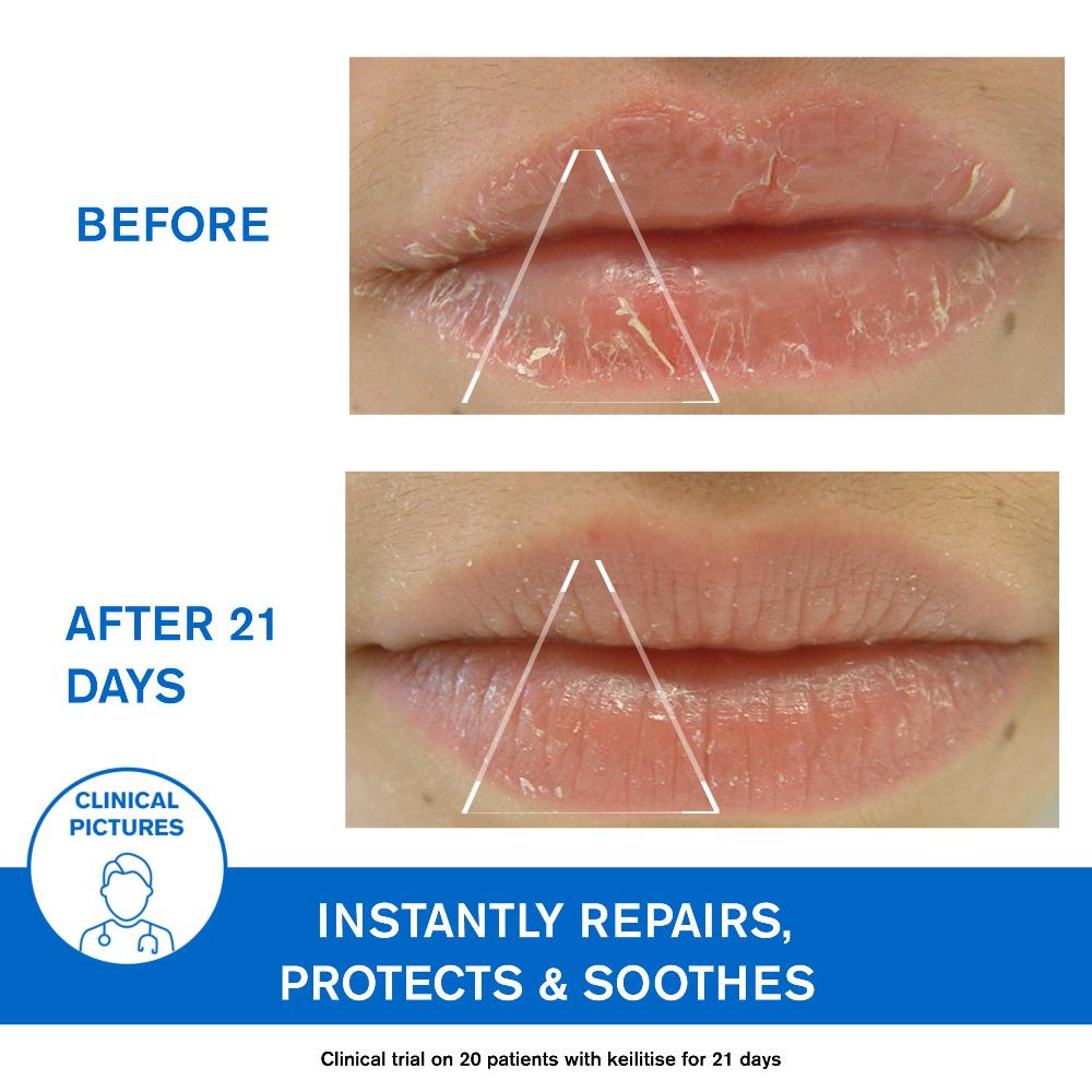 Uriage D.S. Regulating Emulsion, Irritation, Redness, Scales 40ml- Lillys Pharmacy and Health Store