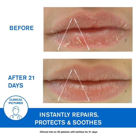 Uriage D.S. Regulating Emulsion, Irritation, Redness, Scales 40ml- Lillys Pharmacy and Health Store